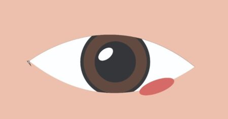 Qual É A Diferença Entre Terçol E Conjuntivite?
