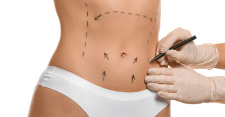 Qual É A Diferença Entre Lipoaspiração E Abdominoplastia?