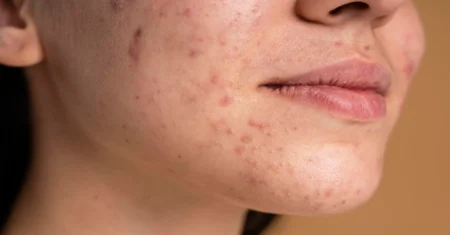 Qual É A Diferença Entre Acne E Espinhas?