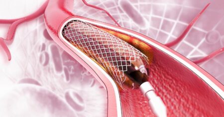 Qual É A Diferença Entre Cateterismo E Angioplastia?