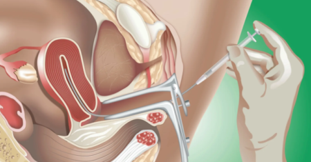 Como Funciona A Inseminação Artificial?