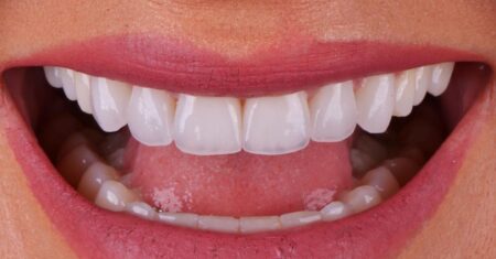 Qual É A Diferença Entre Lente E Faceta?