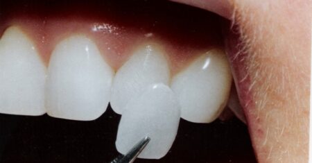 Qual É A Diferença Entre Faceta De Resina E Porcelana?
