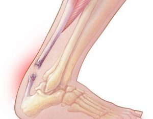 Qual É A Diferença Entre Tendões E Ligamentos?
