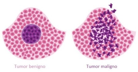 Qual É A Diferença Entre Tumores Benignos E Malignos?