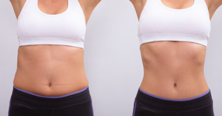 Qual É A Diferença Entre Abdominoplastia E Lipo?