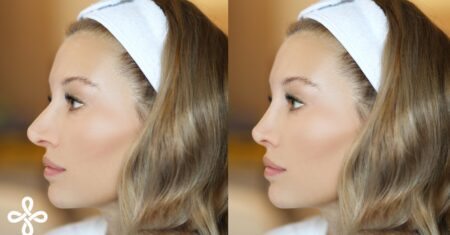 O Que Significa Rinoplastia?