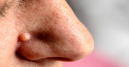 O Que Significa Sonhar Com Verruga?