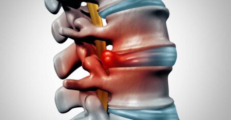 O Que Significa Abaulamento Discal Difuso?