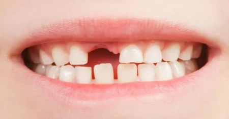 O Que Significa Sonhar Com Dente De Bebê Nascendo?